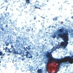 Outbreak of diarrhea-causing parasite grows to more than 1,000 cases